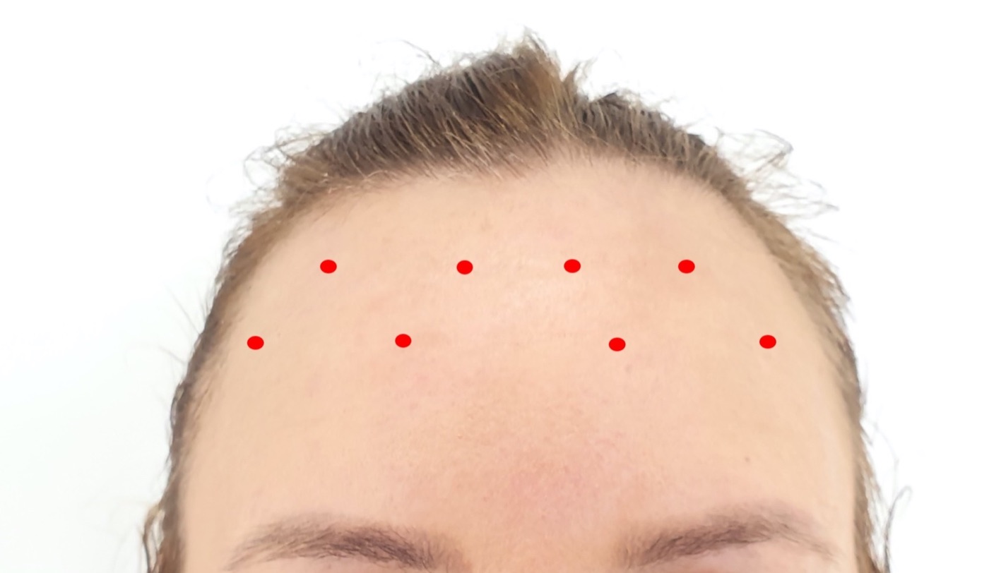 Forehead with eight red dots marking the injection points, four per side in two rows