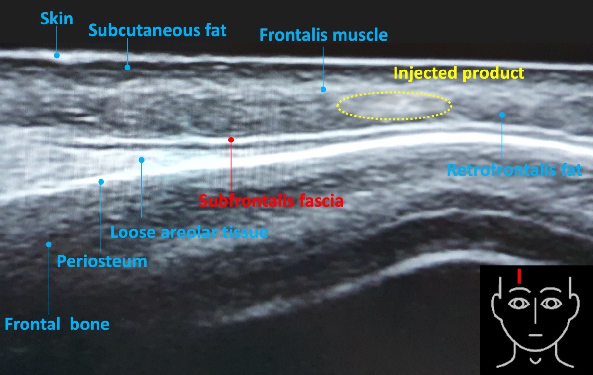 Ultrasound of forehead showing injected product in subcutaneous fat above the frontalis