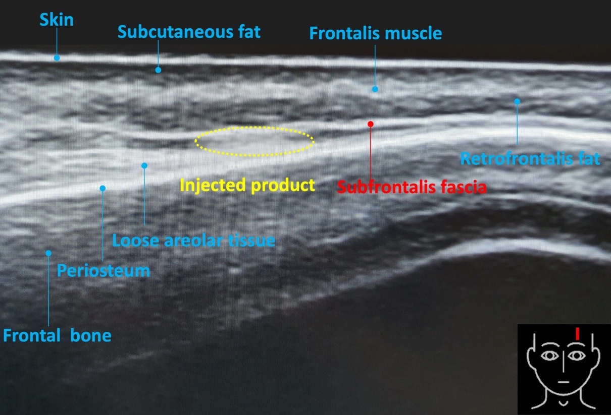 Ultrasound of forehead showing injected product in the loose areolar plane beneath the subfrontalis fascia on bone
