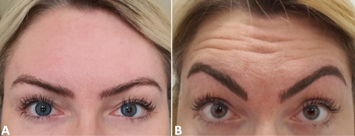 Baseline photos of a participant at rest and with deep horizontal forehead lines on maximal frontalis contraction