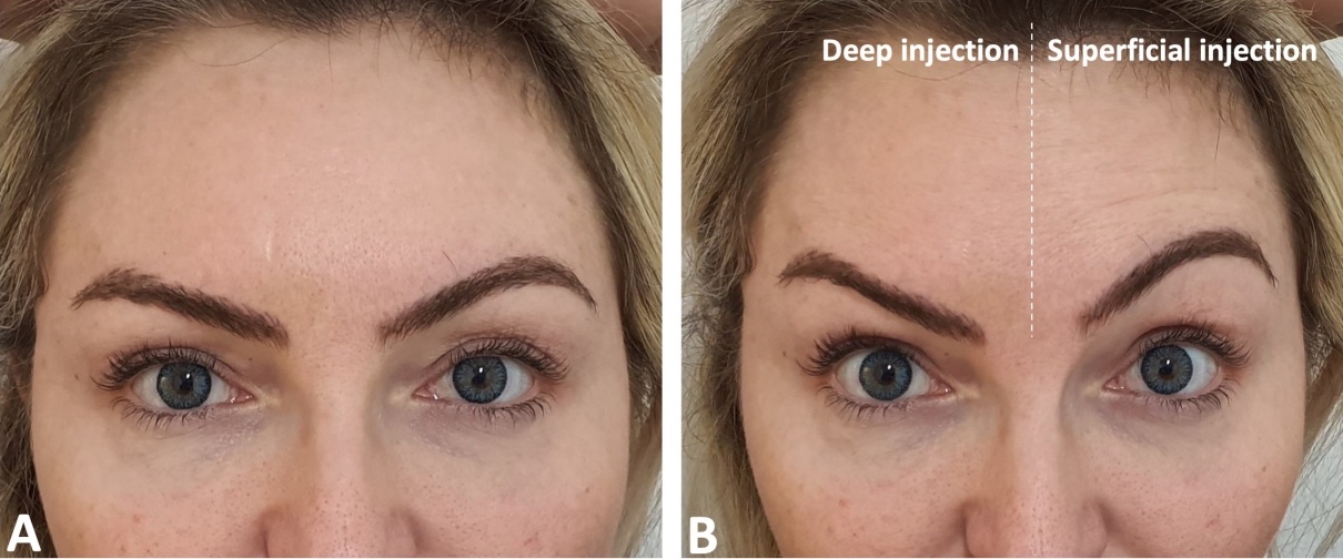 Day 14 photos: on contraction the deep-injected side is smooth while the superficial side shows lines and a raised lateral brow